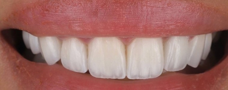 After veneers
