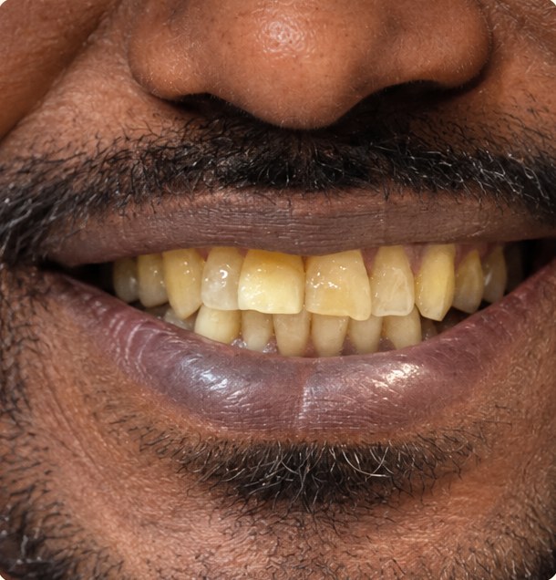 Before veneers
