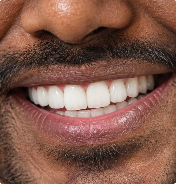 After veneers