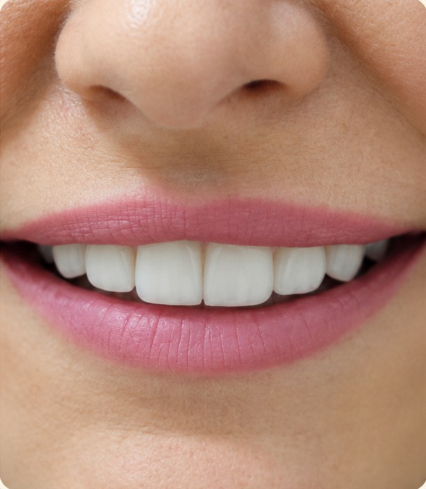 After veneers