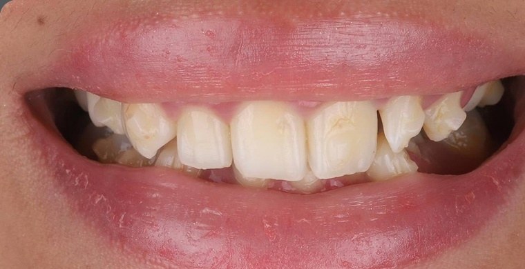 Before veneers