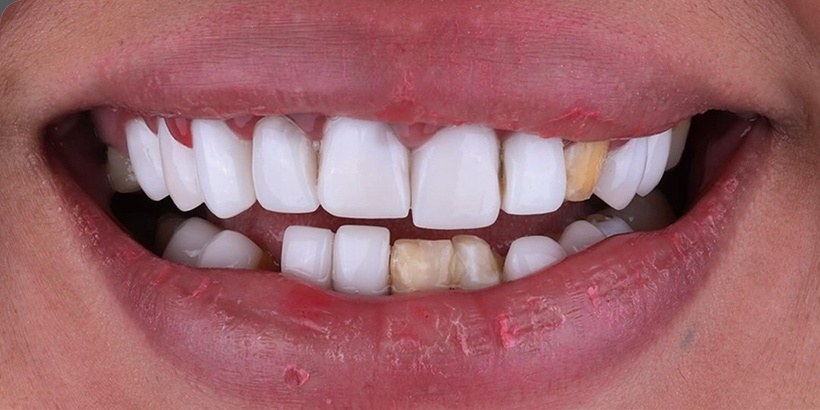 Before veneers