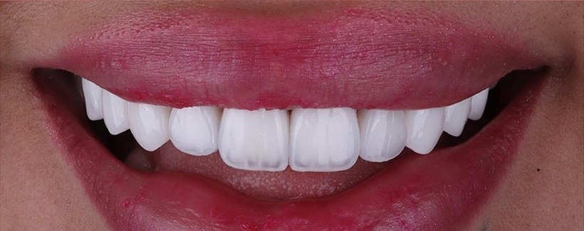 After veneers