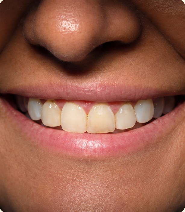 Before veneers